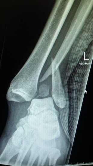 발목 골절: 원인, 증상, 치료 및 회복 과정