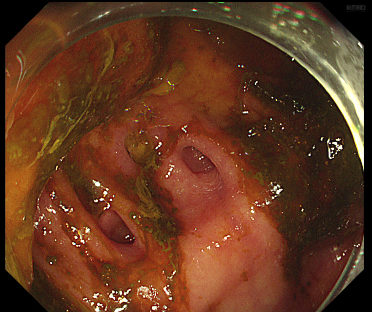 대장내시경 전 음식주의사항