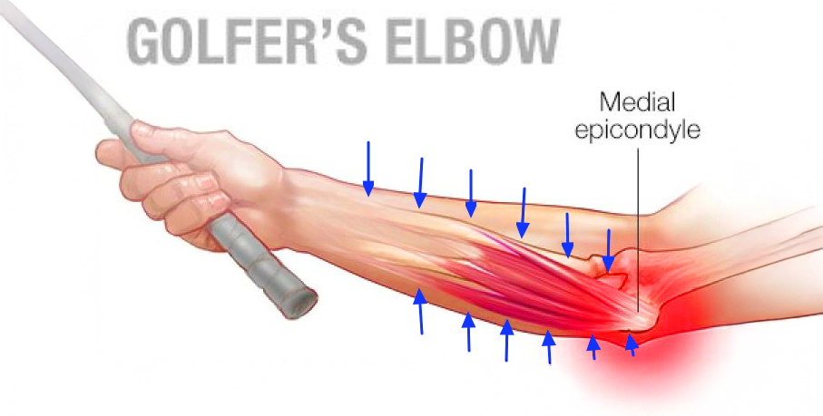 골프 엘보 부상 부위와 해결책