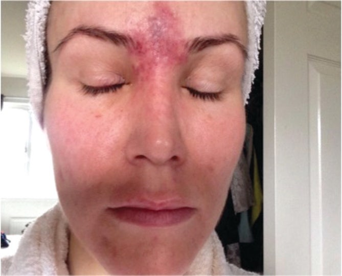 미간 주름 필러