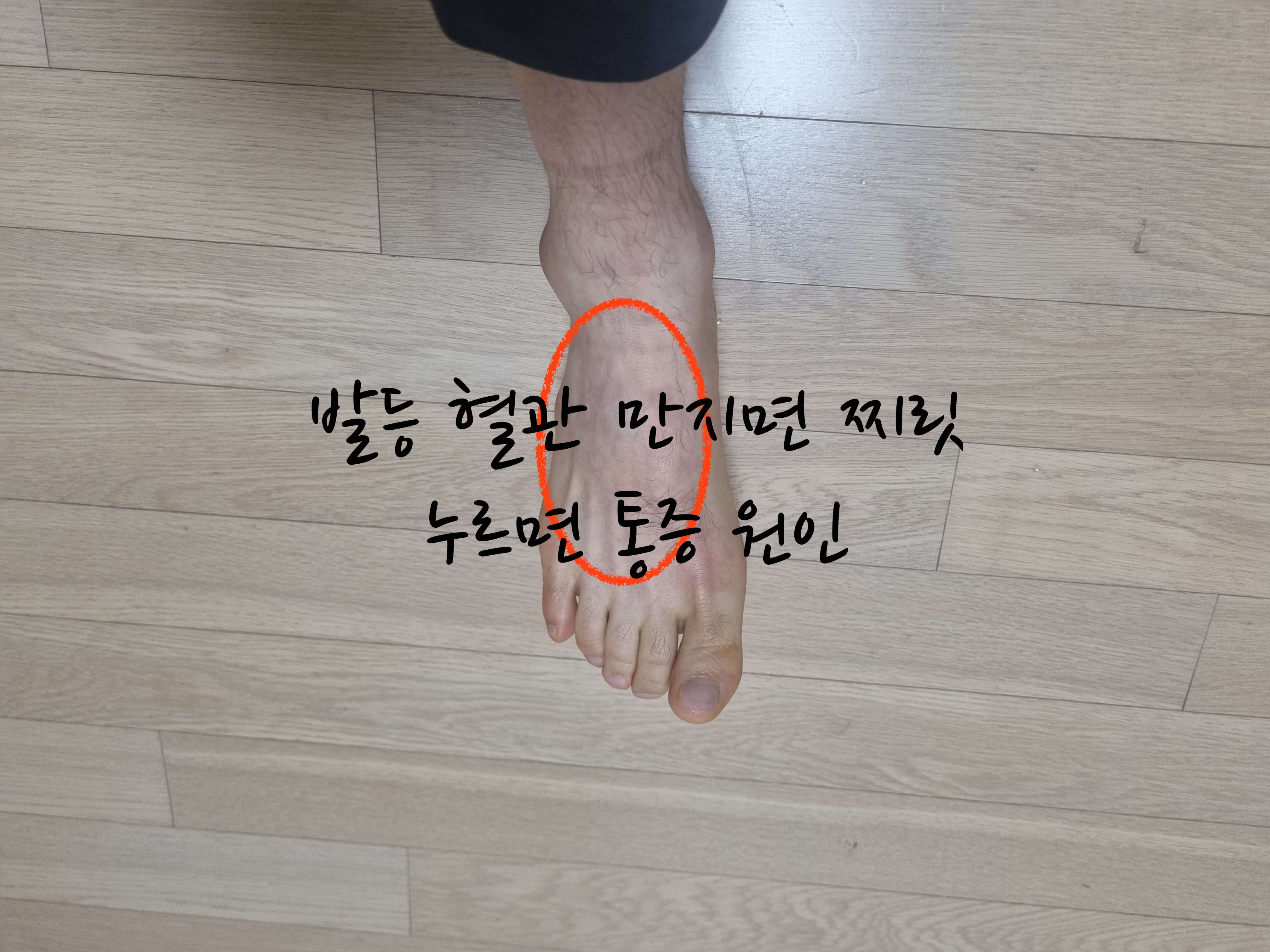 발등 혈관 통증
