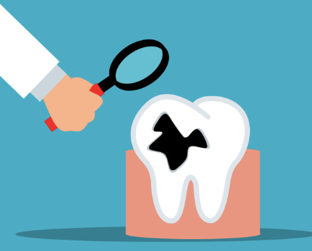 충치가 생기는 이유