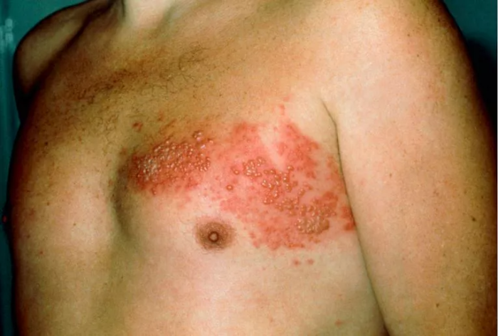 발진-가슴