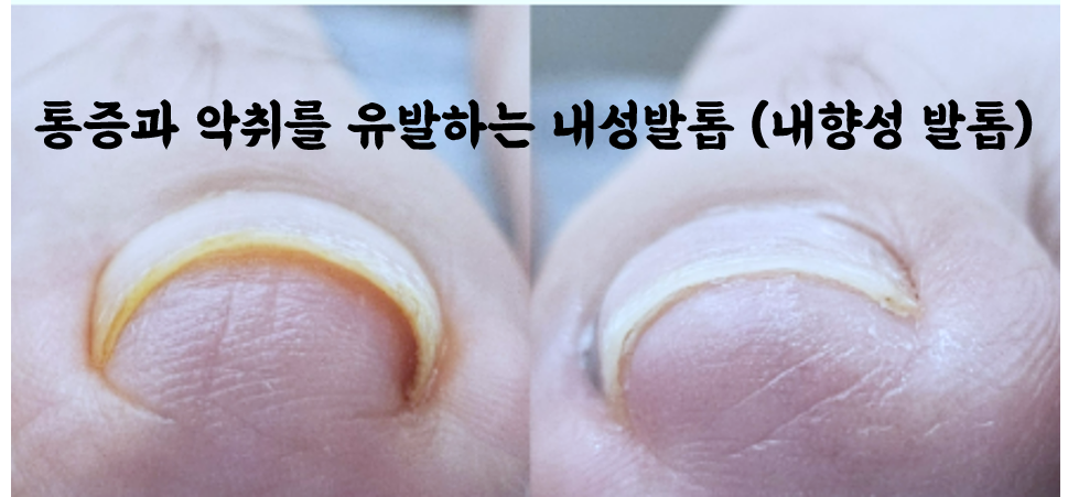 부산 내향성 발톱 
