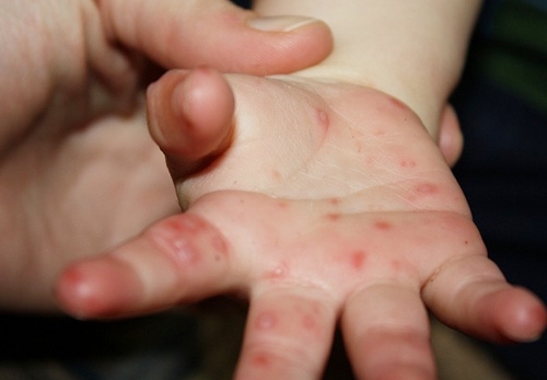 수족구병 증상 예방조치