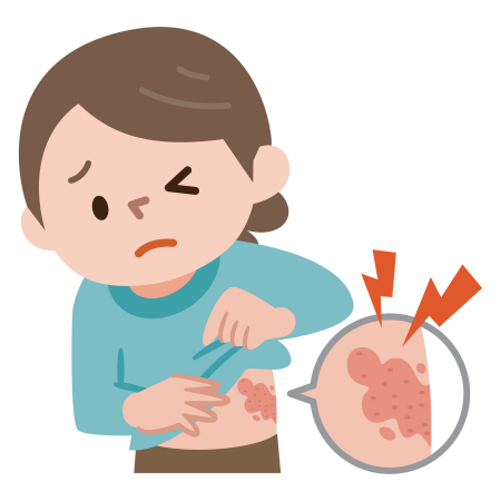 대상포진 herpes zoster