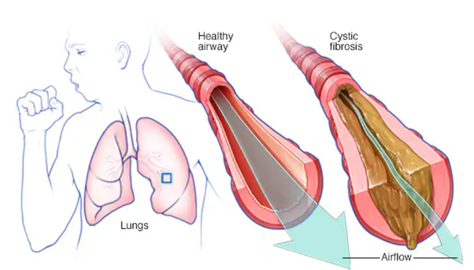정상인 기도와 걸쭉하고 끈적한 점액으로 채워져 있는 기도의 모습