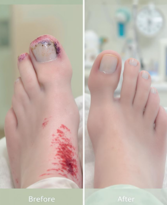 발톱이 두꺼워지는 이유 건강 신호일까 5