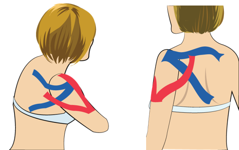 어깨 통증 (일반)