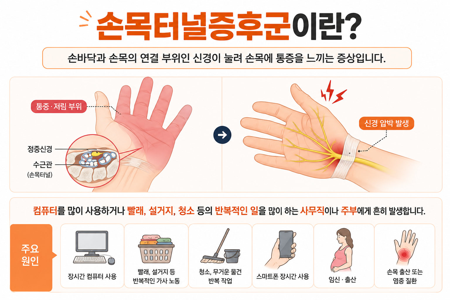 손목터널증후군에 대한 설명