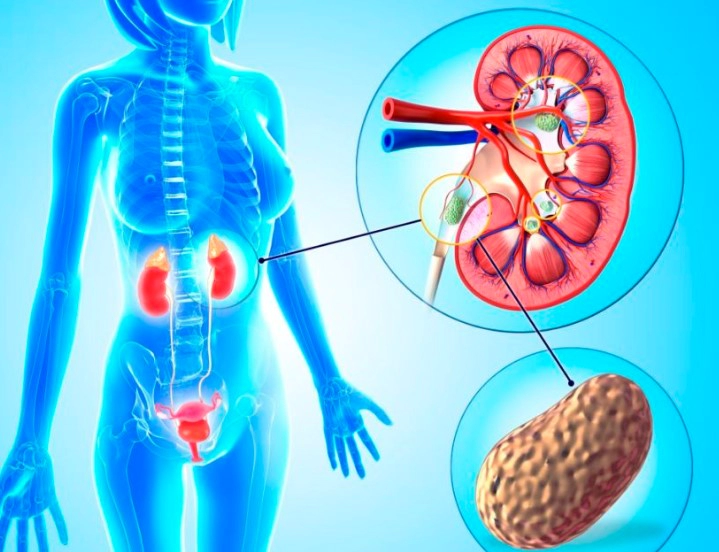 신장 결석 증상 4가지