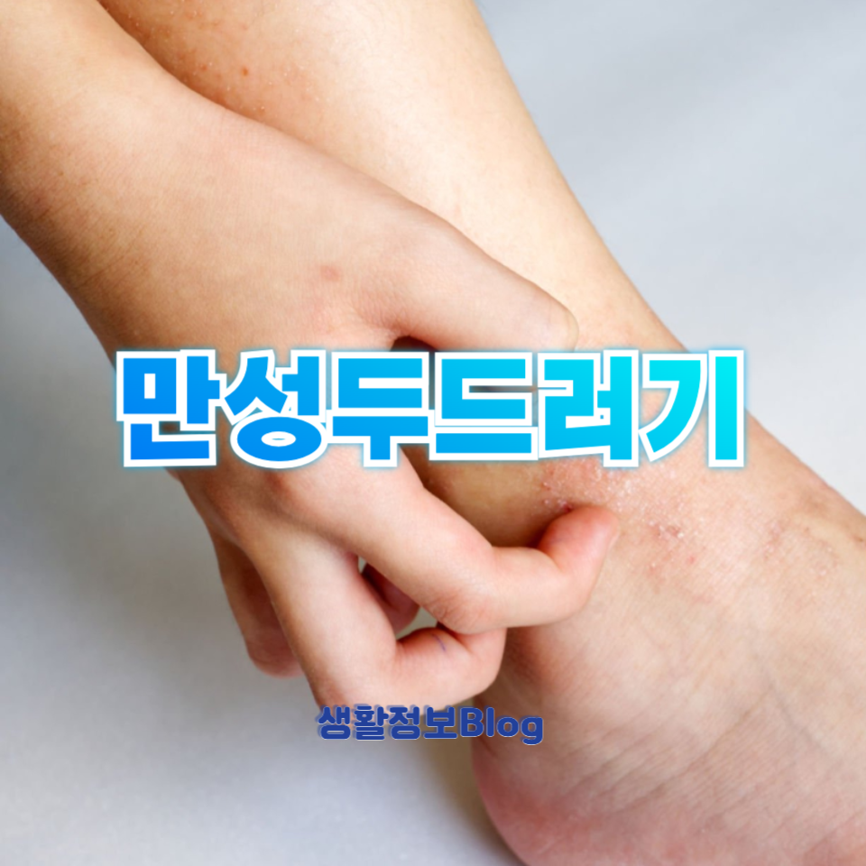 만성두드러기