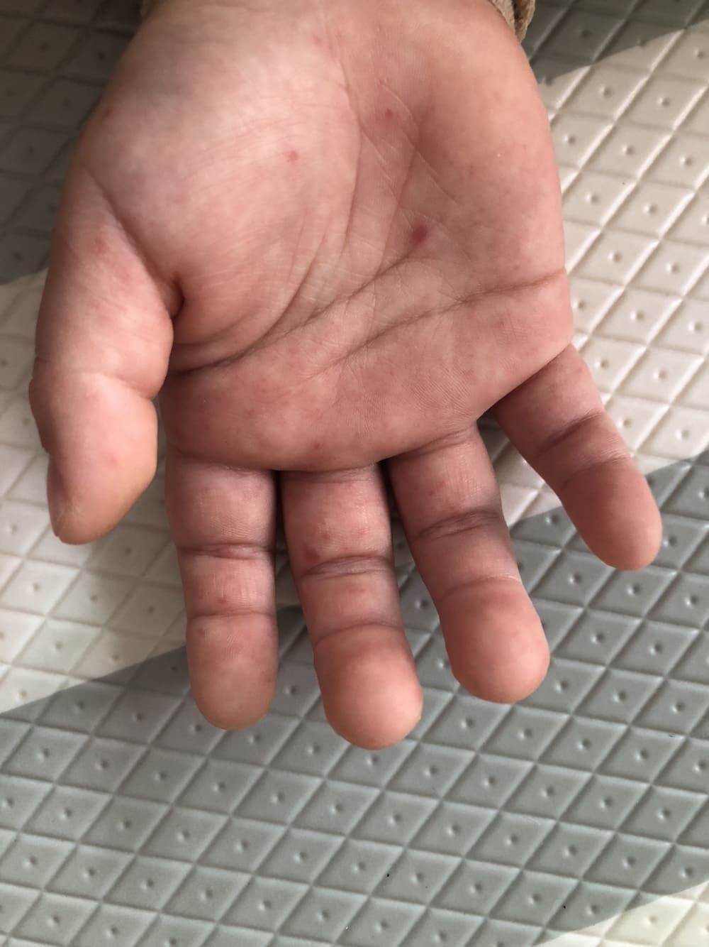 첫째아이 오른손붉은발진