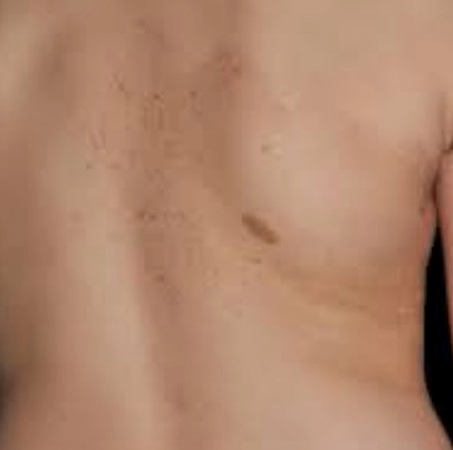 신경섬유종 밀크반점 증상 7가지