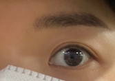 결막모반 제거 후기