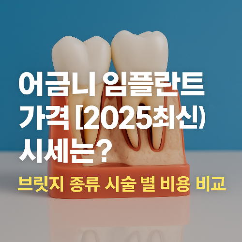 어금니 임플란트 가격 [2025최신] 시세는? 브릿지 종류 시술 별 비용 비교