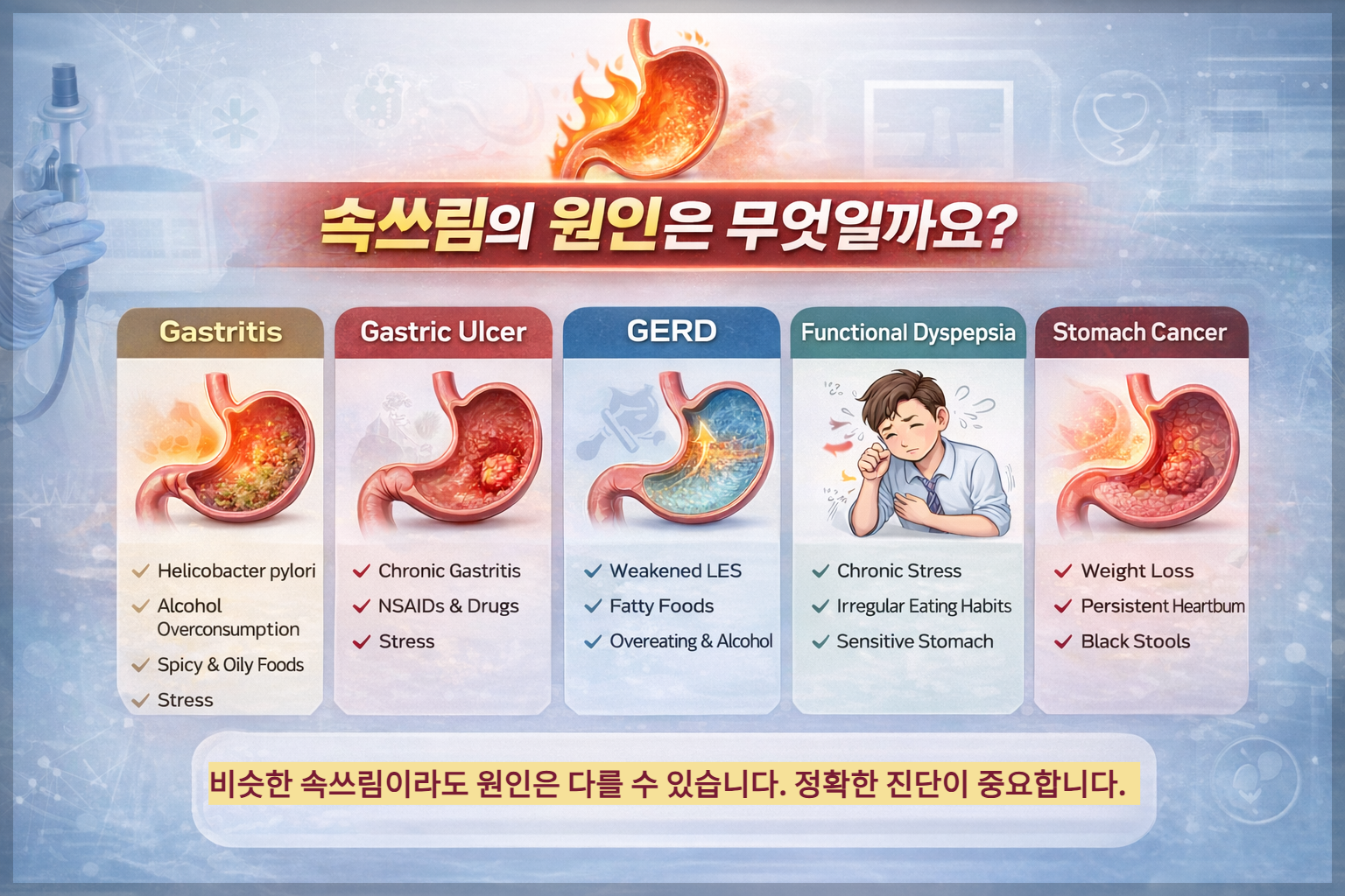 속쓰림 원인과 위 질환 종류 비교 이미지 위염 위궤양 역류성 식도염 위암