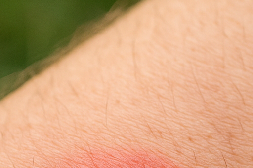 쯔쯔가무시 진드기 물린 자국