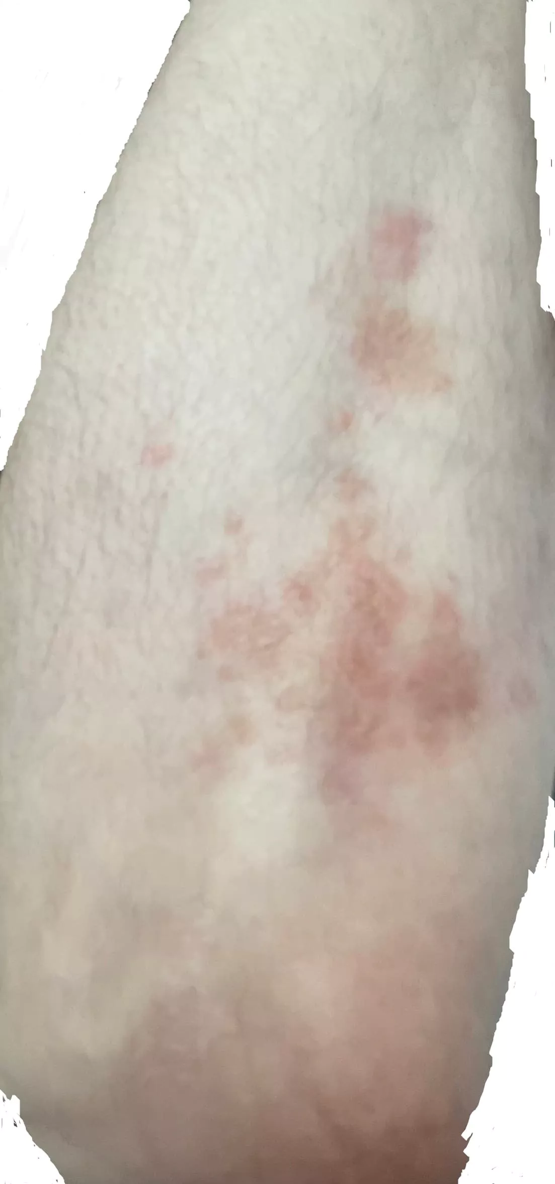 사진2-스킬라렌스-복용-10주차-오른팔-건선-현황