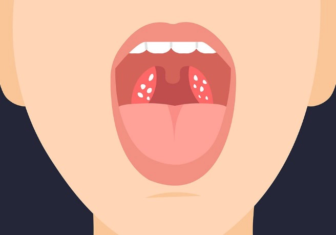 편도결석 빼는법