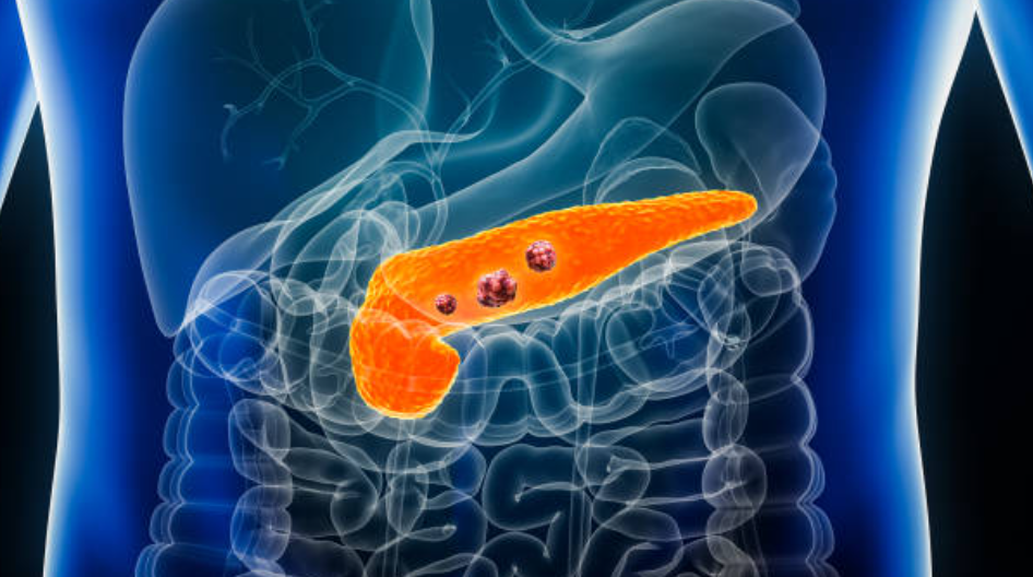 췌장암과 관련된 사진1