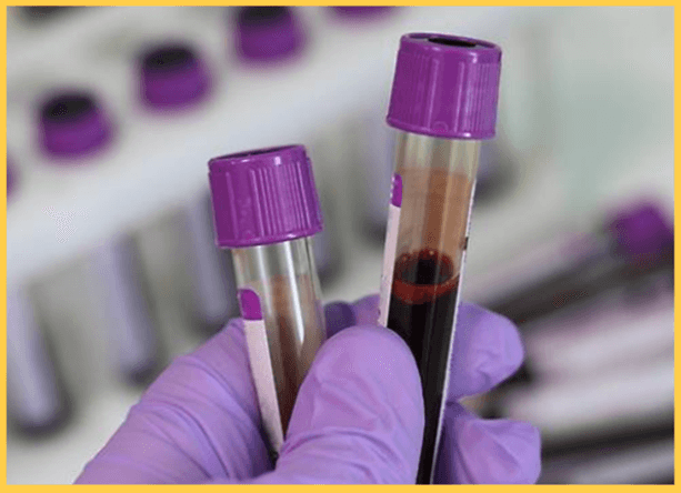 고지혈증 검사 비용