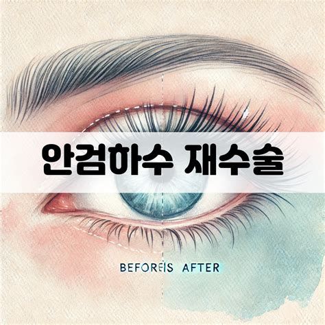 안검하수 비용