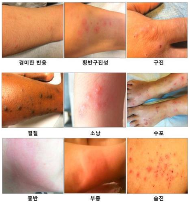 빈대 물린자국 증상 (출처=질병관리청)