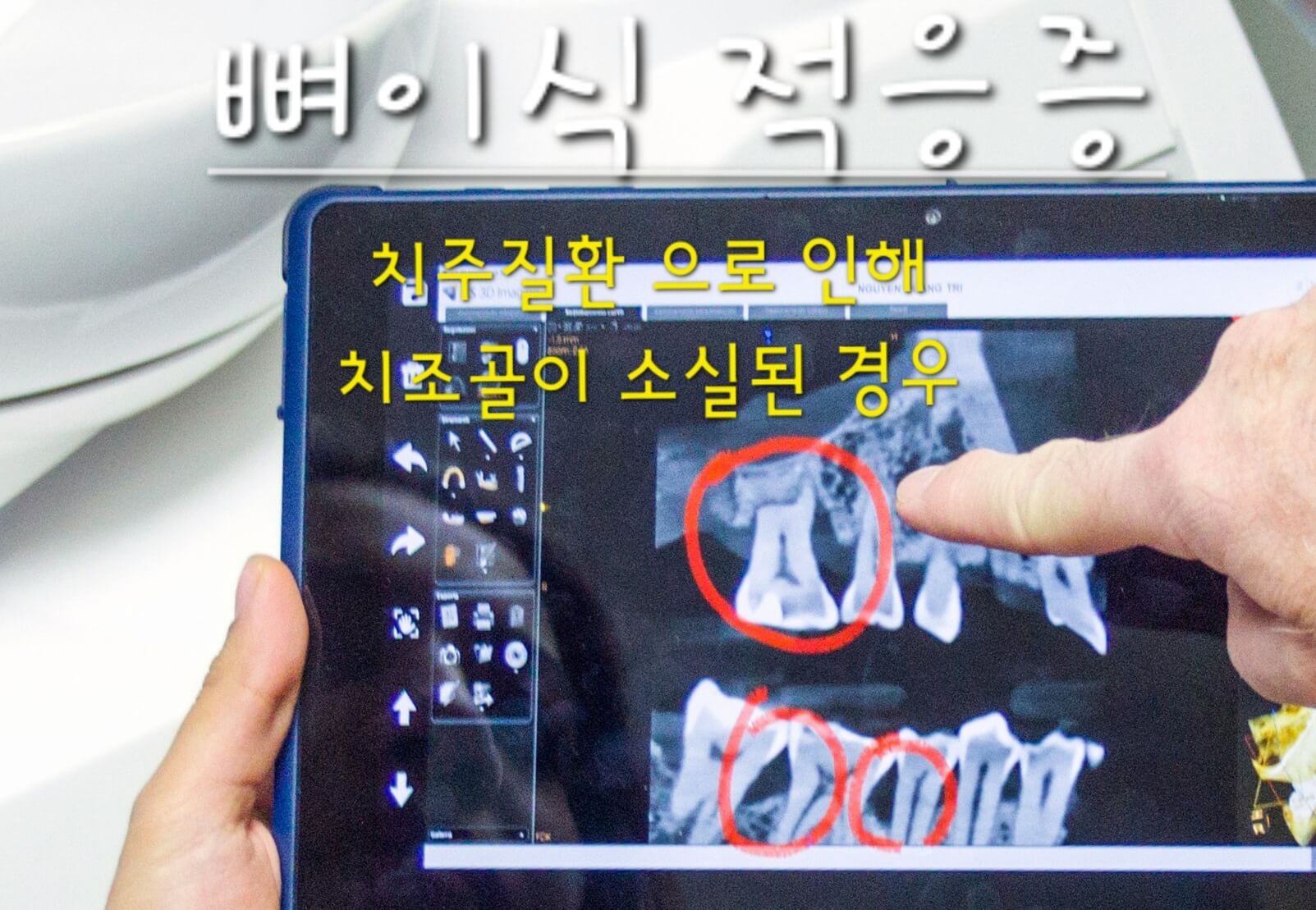 뼈이식 적응증 치주질환 사진