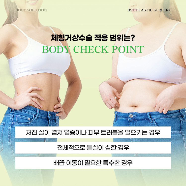 체형거상수술 적용 범위는?
1. 처진살이 겹쳐 염증이나 피부 트러블을 일으키는 경우
2. 전체적으로 튼살이 심한 경우
3. 배꼽 이동이 필요한 특수한 경우