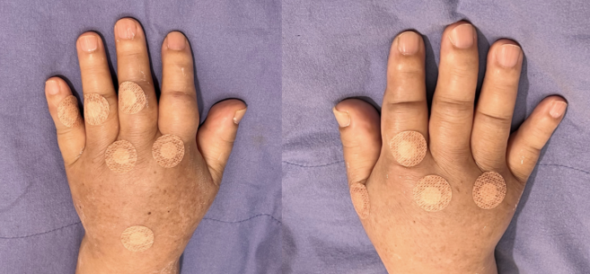 류마티스 관절염3