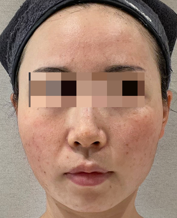 동안 얼굴 만들기 논현동 여드름 피부과