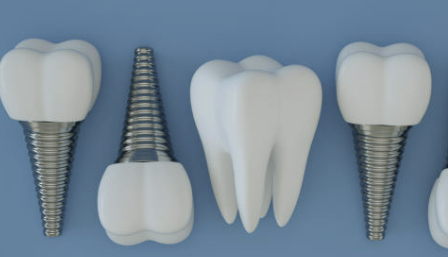 임플란트 가격 확인 최저가 확인 시술기간 (최신)