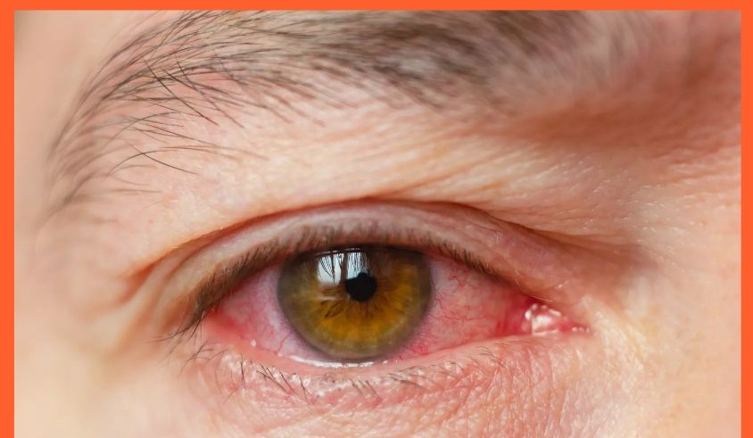 포도막염 증상 원인