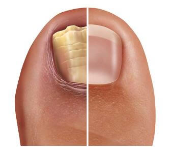 발톱 무좀 상태