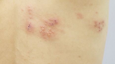 대상포진 초기증상