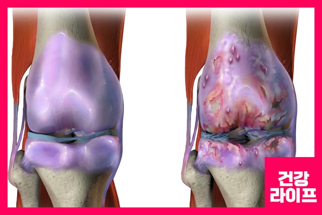 류마티스 관절염 치료