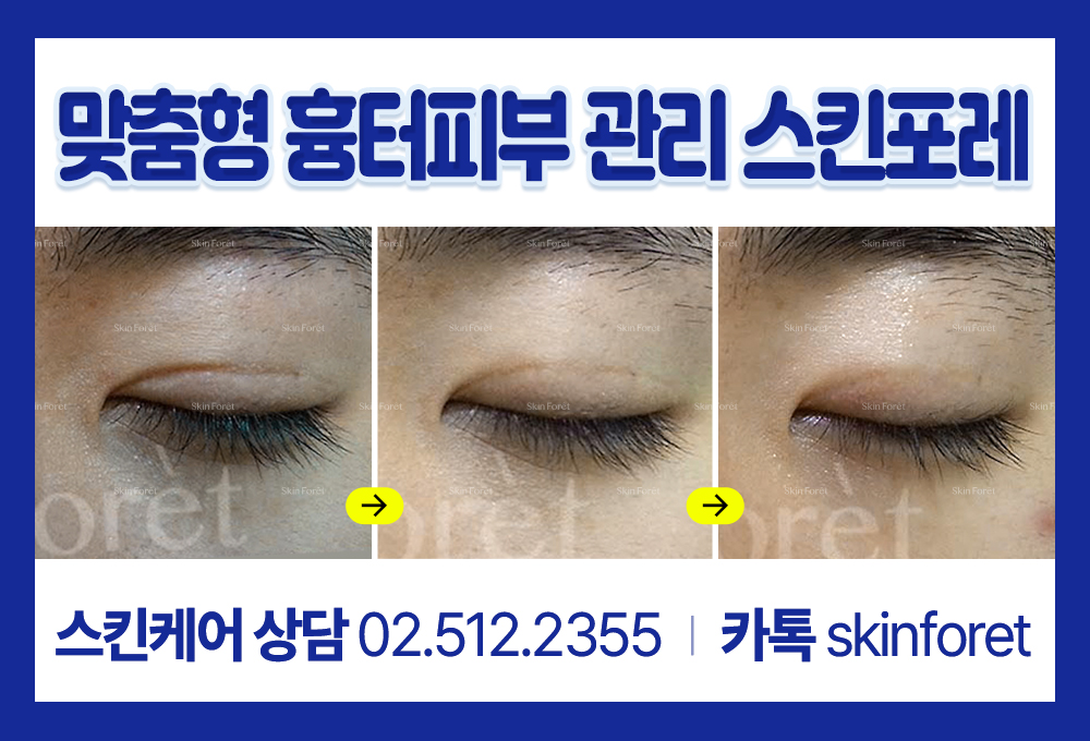 남자 짝눈 교정과 쌍수 수술 흉터 회복 이미지
