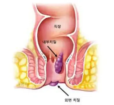 내치질 외치질 증상 차이