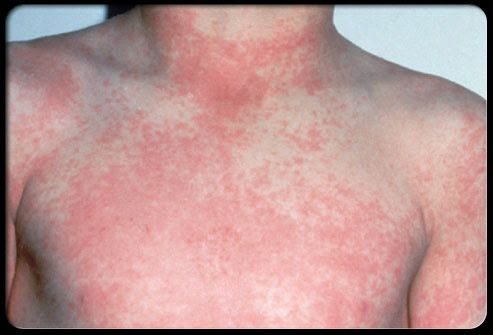 성홍열 증상, 원인, 치료