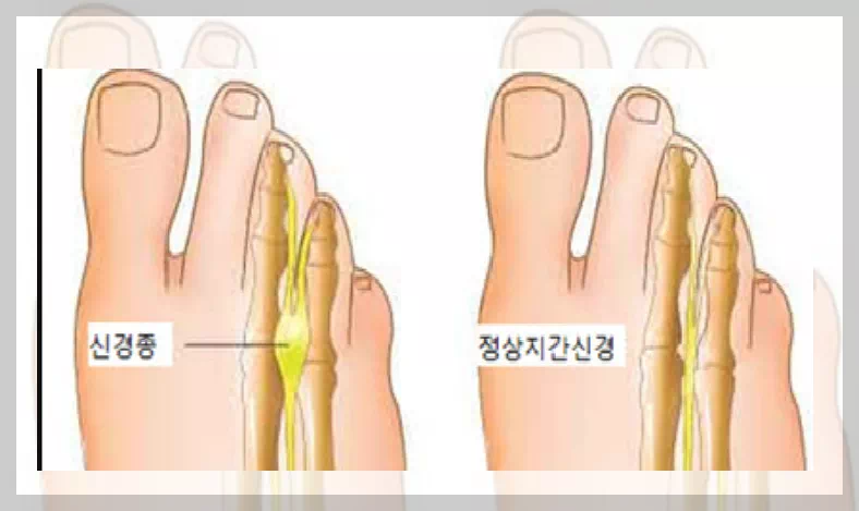 신경종 위치