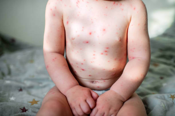 대상포진 예방접종 비용확인 초기증상 치료