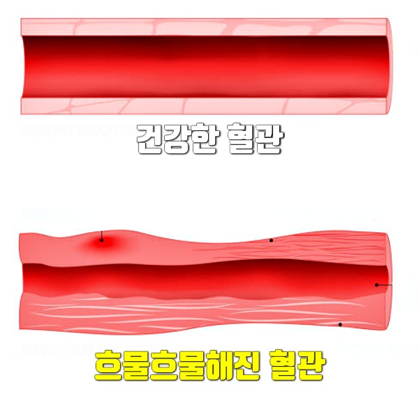 뇌출혈 원인 고혈압에 좋은 음식, 혈관에 좋은 음식,건강,팁줌