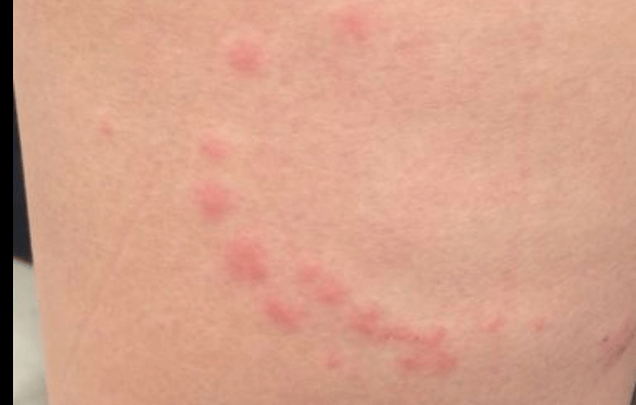 여행중빈대(베드버그)피하는법-빈대특성분석