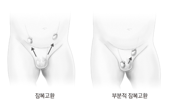 잠복고환