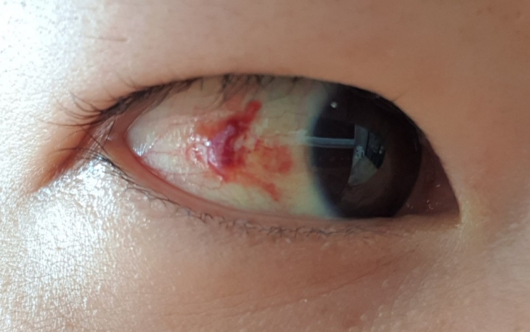 눈 물집 제거 후 5일째