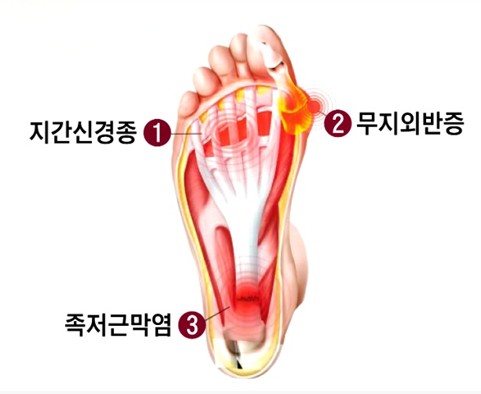 발바닥 통증 : 원인과 예방, 치료 방법