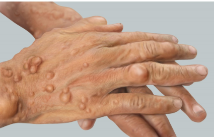 종양이 커지면서 신경을 압박하면 감각 이상, 근육 약화, 심한 경우 통증까지 유발