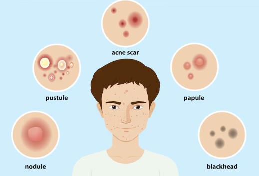 대상포진-예방-접종-비용-가격-1