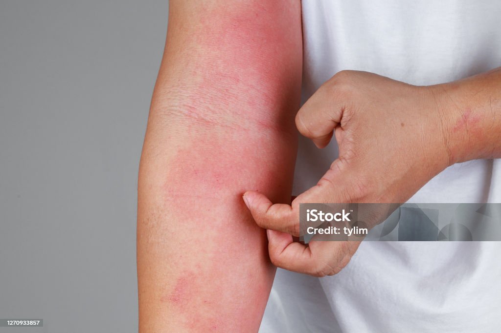 가려움증에는 다양한 원인이 있으니 무작정 긁으면 안 된다